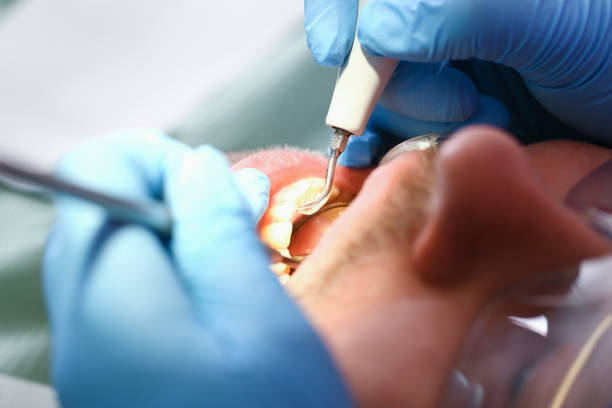 Best Emergency Wisdom Teeth Removal in North Bethesda, MD